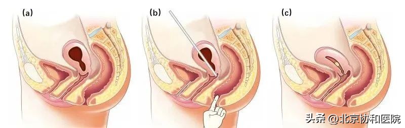协和医院在ScienceBulletin发表先天性子宫颈发育不良诊断及手术治疗新观点