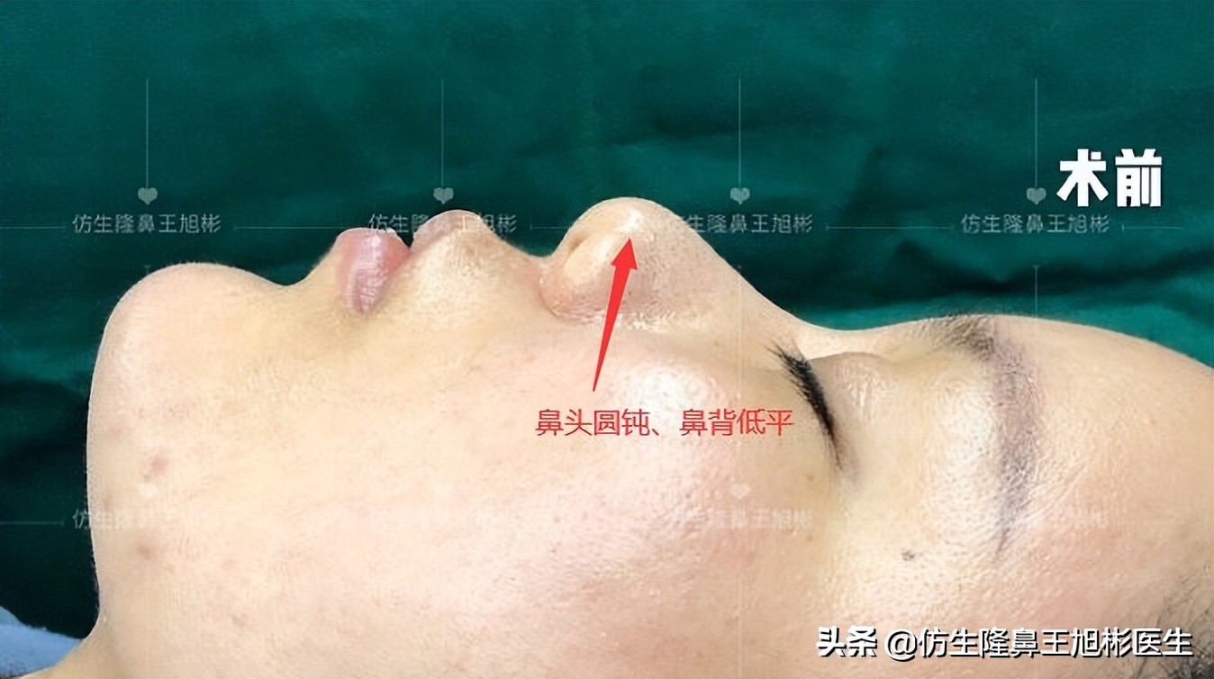 鼻头部位整形,鼻头圆钝高鼻梁整形案例