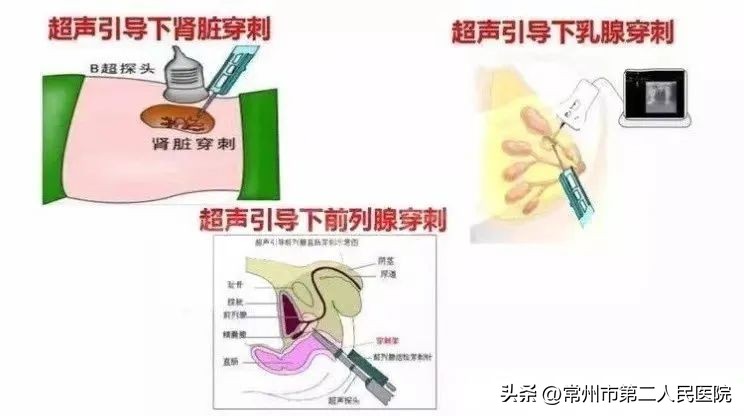 小针孔，用途多，漫画带你了解介入超声能做啥？
