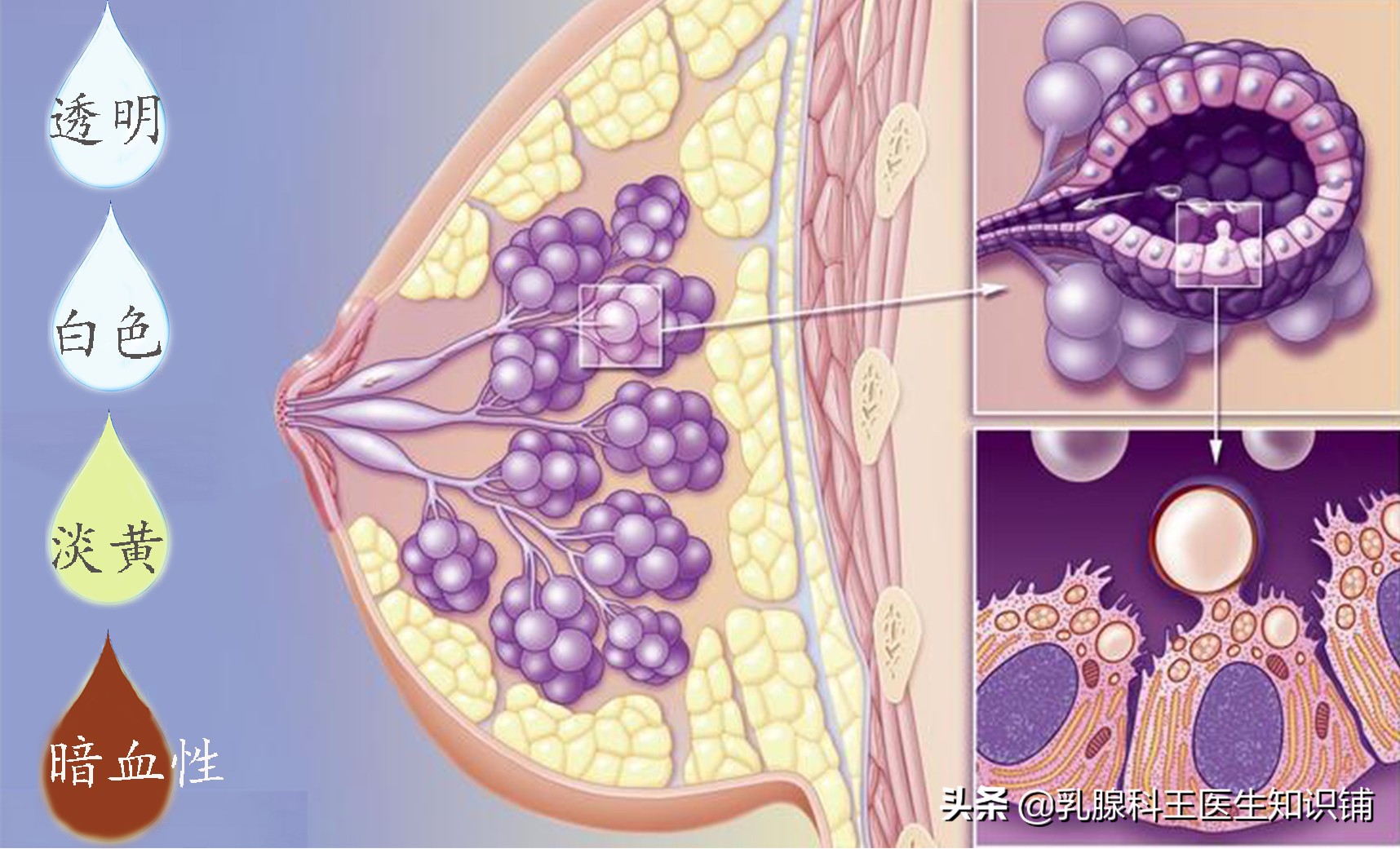 乳头出现溢液你需要进行这些检查、治疗和预防(下)