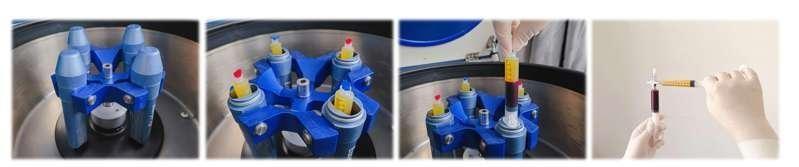 关节prp治疗要打麻药吗,风湿性关节炎prp