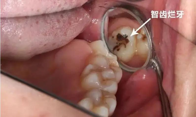 自从长了智齿，总是咬到腮帮子怎么办？专家：建议拔除