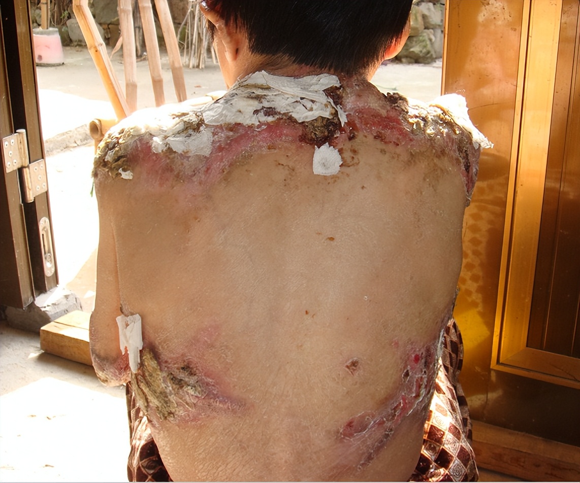 遗传性大疱性表皮松解症症状原因,新生儿大疱性表皮松解症能治愈吗