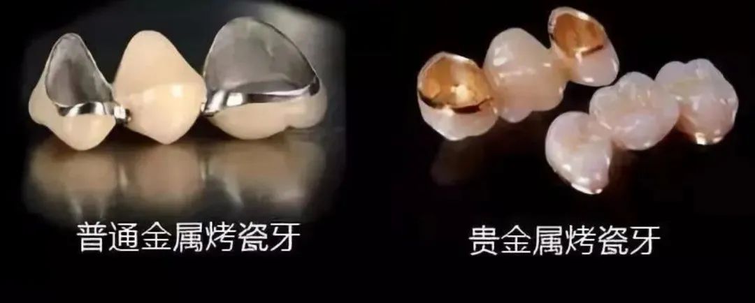 缺牙后哪种补牙性价比高,缺牙想补牙去哪里比较划算