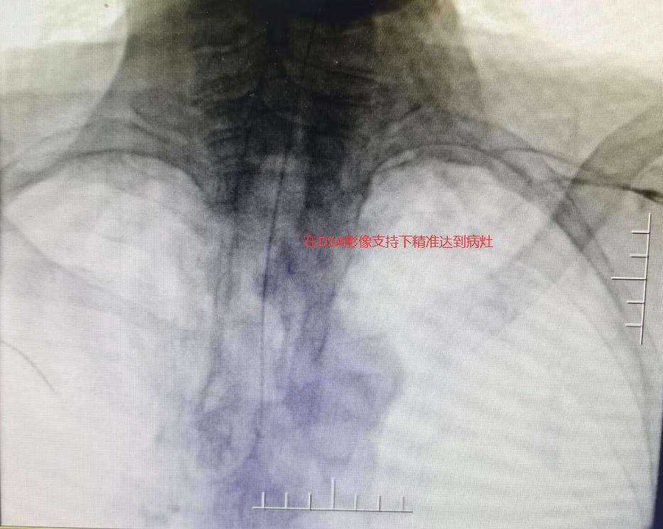 食管癌气管瘘案例,食管癌并发吻合口瘘的案例介绍