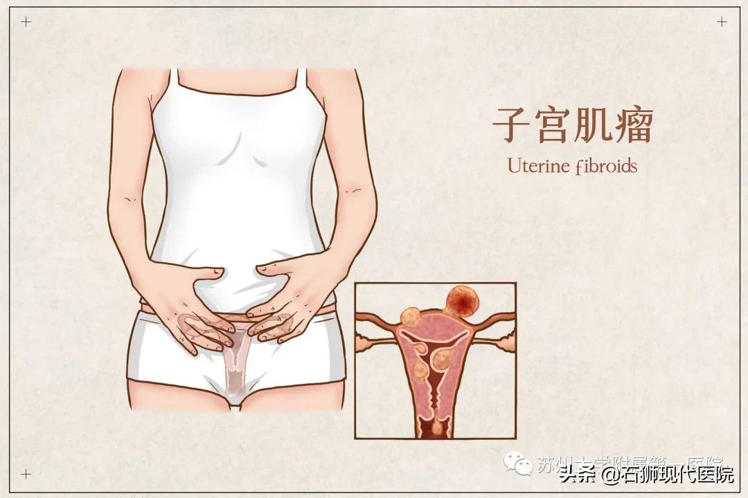 孕妈妈子宫肌瘤,28岁孕检发现子宫肌瘤多发