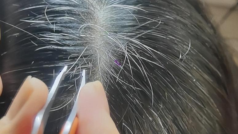 白头发越长越多是缺了两种营养,白头发增多是缺少什么营养素吗