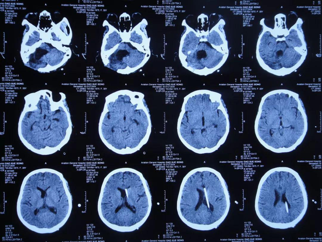听神经瘤出现脑积水和出血,听神经瘤手术后颅压高症状