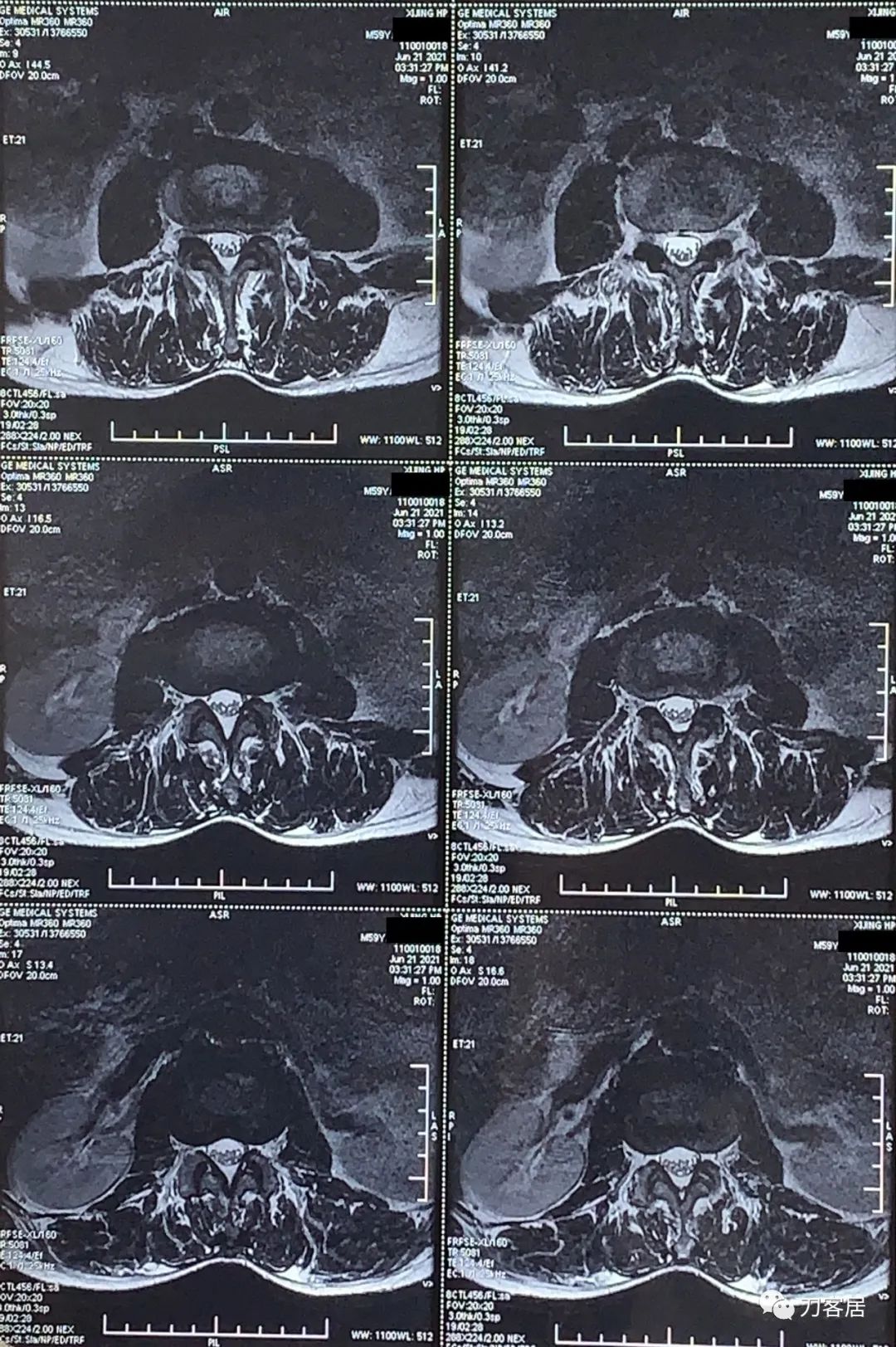 髋部疼痛小腿肌肉肿胀,髋骨疼小腿抽筋