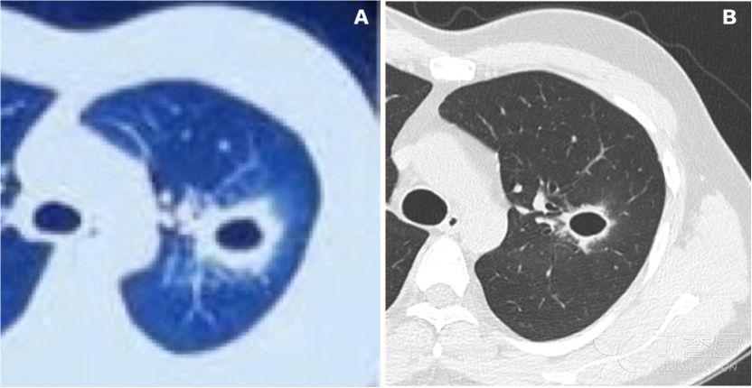 女52岁咳嗽咯血的ct诊断,老是咳嗽结果是肺脓肿