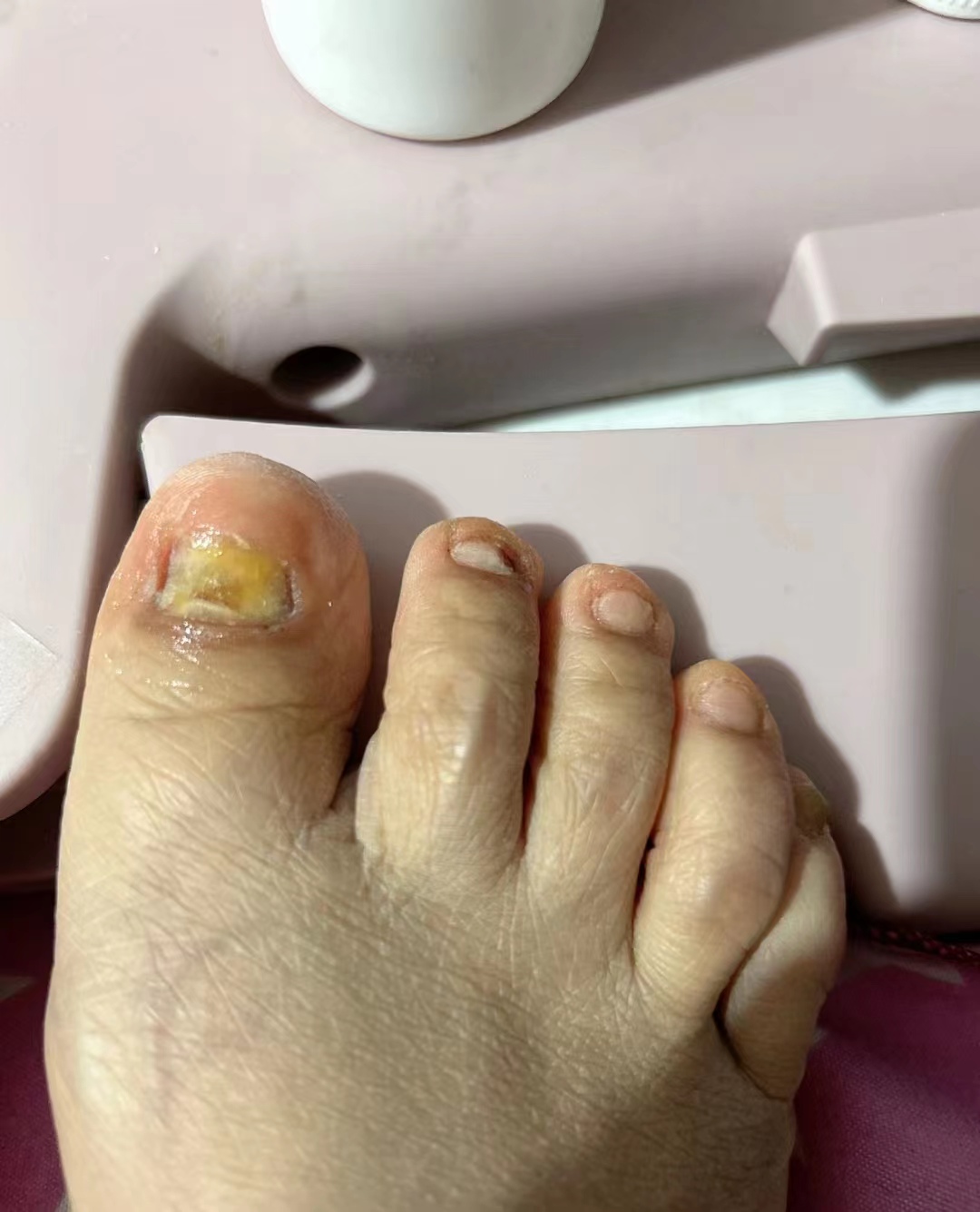 灰指甲到底怎么才能彻底治好,灰指甲用什么方法能彻底根除