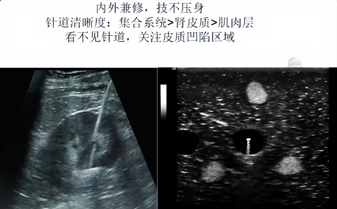 明知山有虎,偏向虎山行——肾斗士VS肾结石