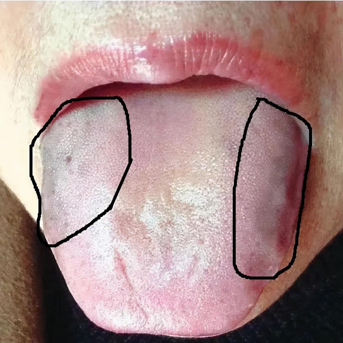 舌诊辨证和精准用药,中医诊病无需诊脉和观舌象靠谱不