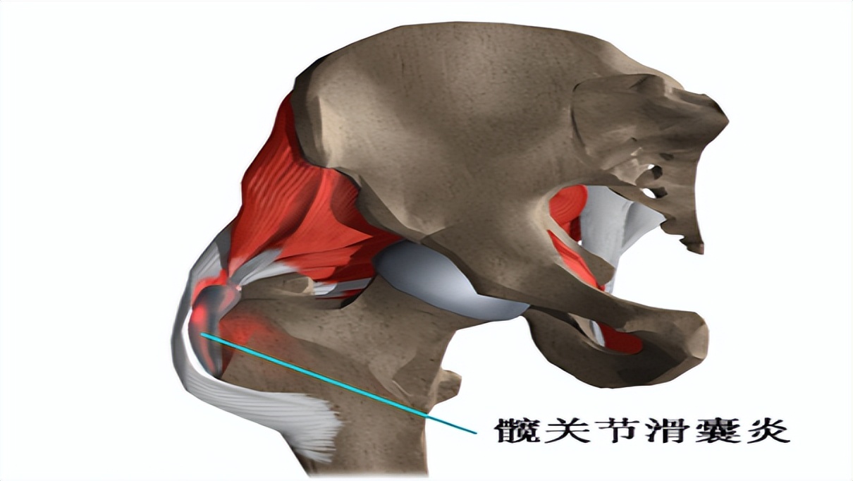 胯骨疼与哪些疾病有关,胯骨疼痛要警惕什么病