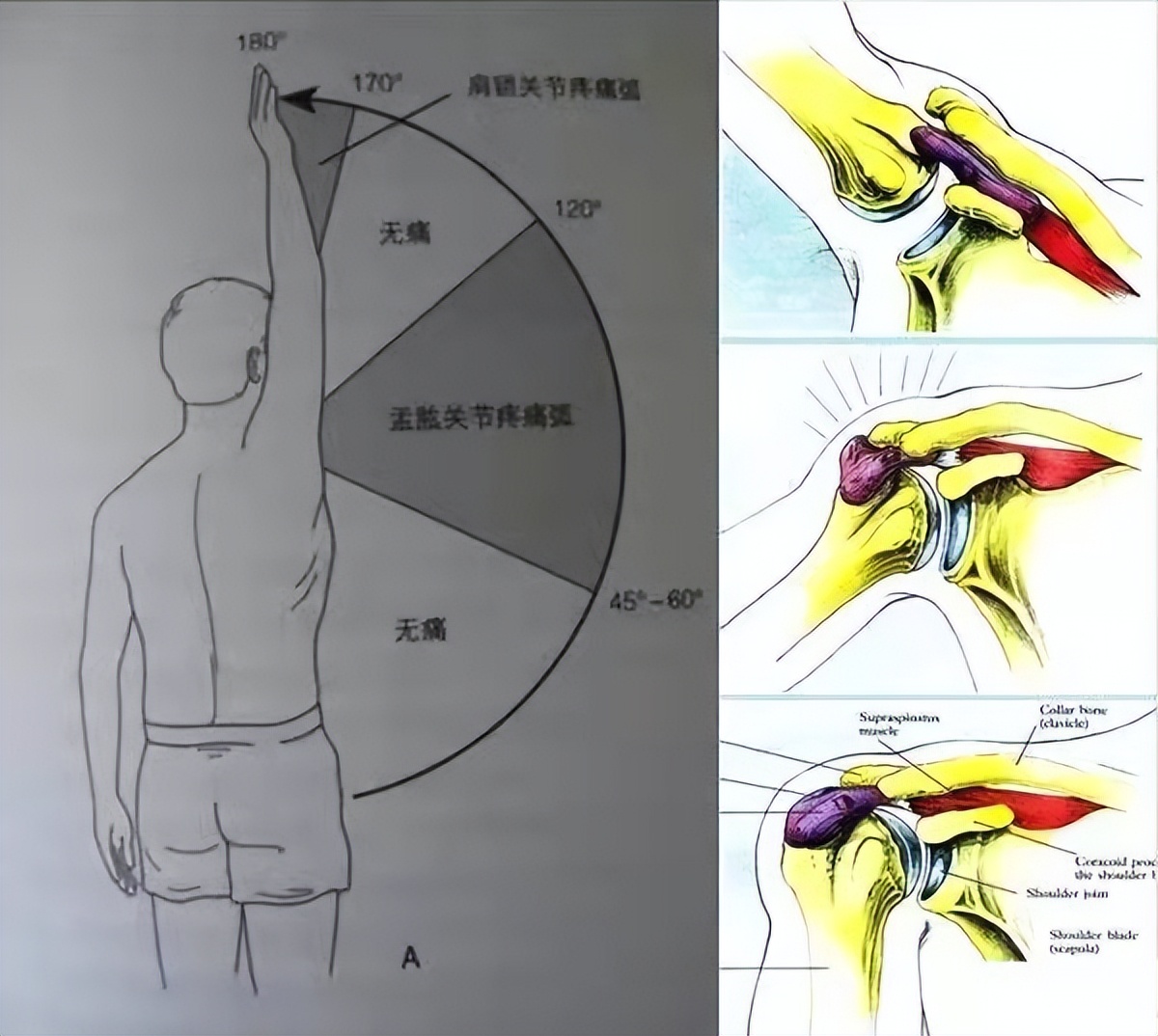 肩部腱膜炎,肩胛冈上肌腱炎的治疗