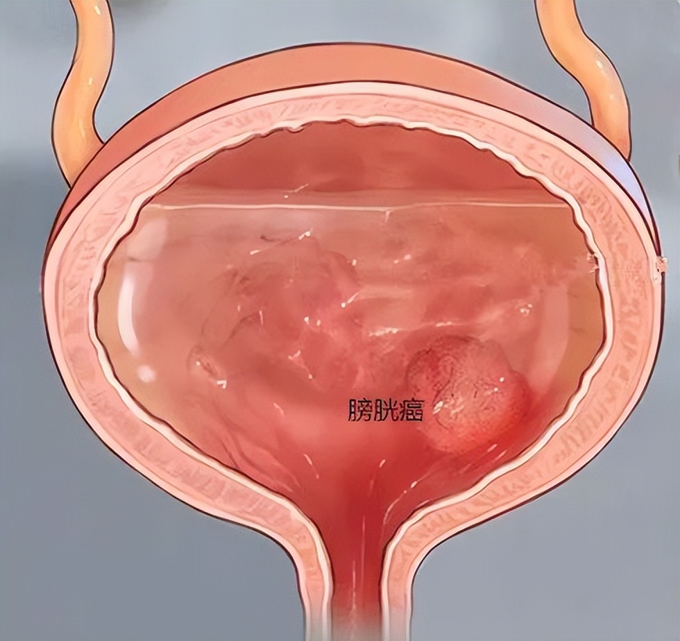 膀胱偏小有什么症状,小膀胱综合征