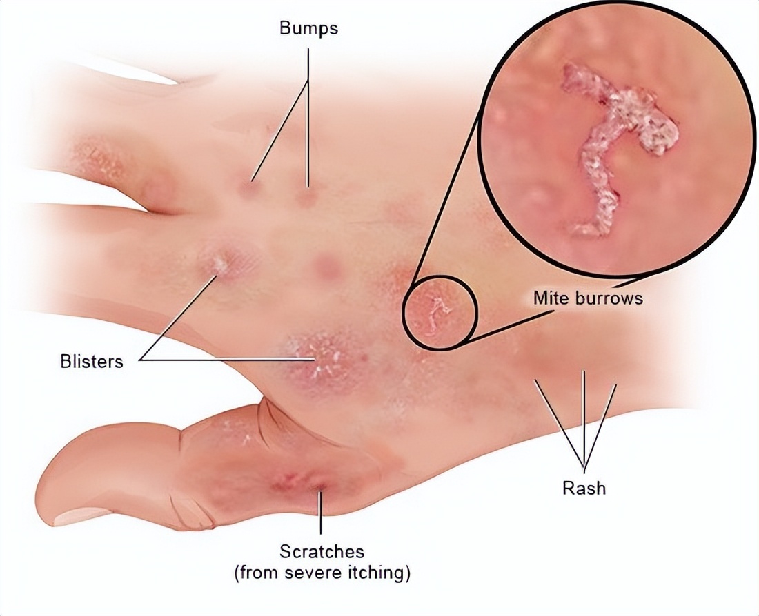 如何处理疥疮,疥疮会自愈吗