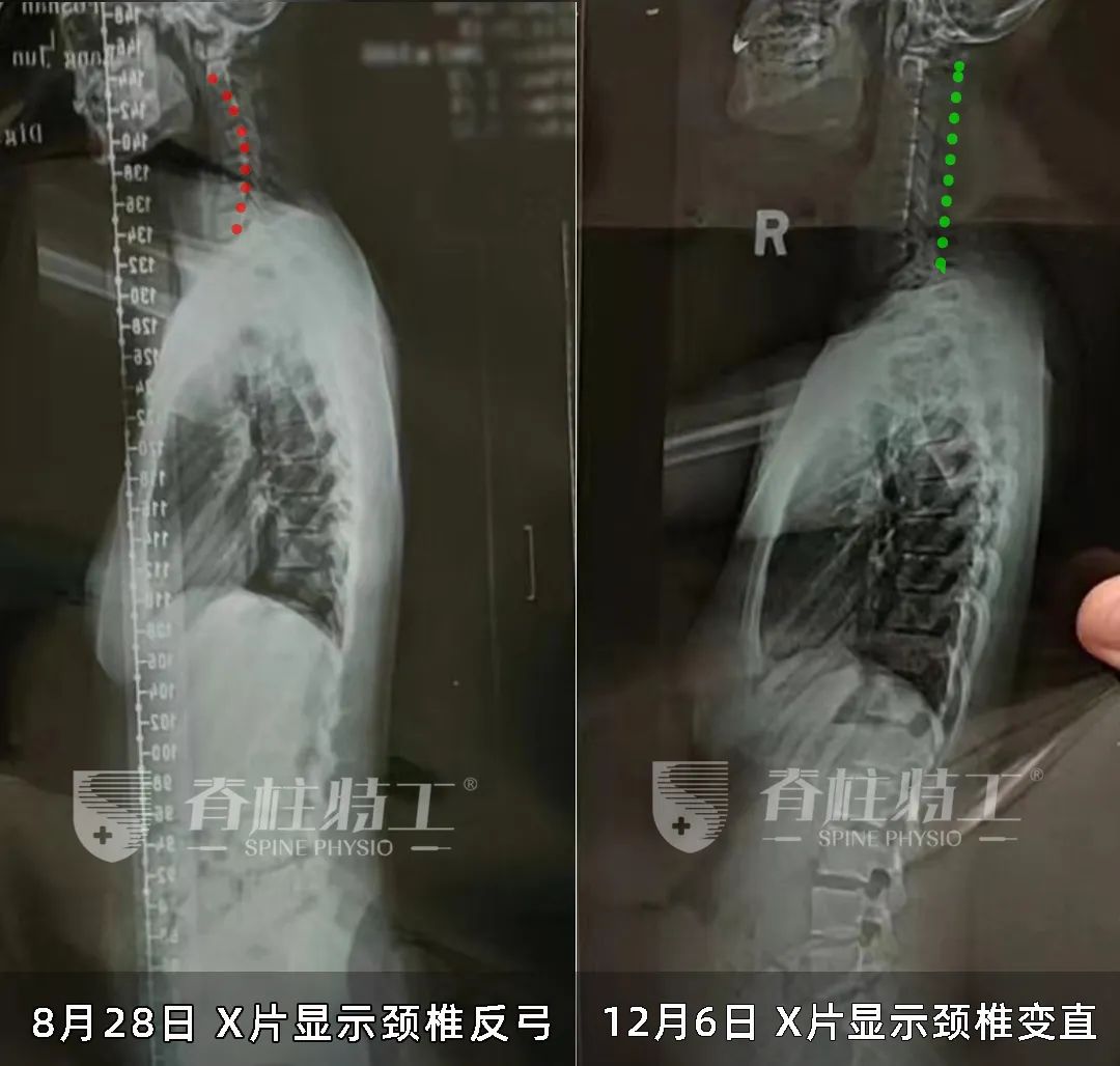 错误的躺姿对颈椎的影响,20岁颈椎反弓是不是废了