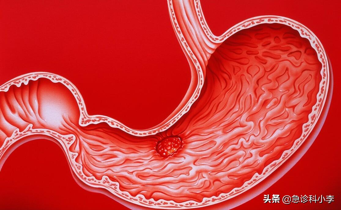 幽门螺杆菌导致的胃癌如何治疗,幽门螺杆菌根除了还会得胃癌吗