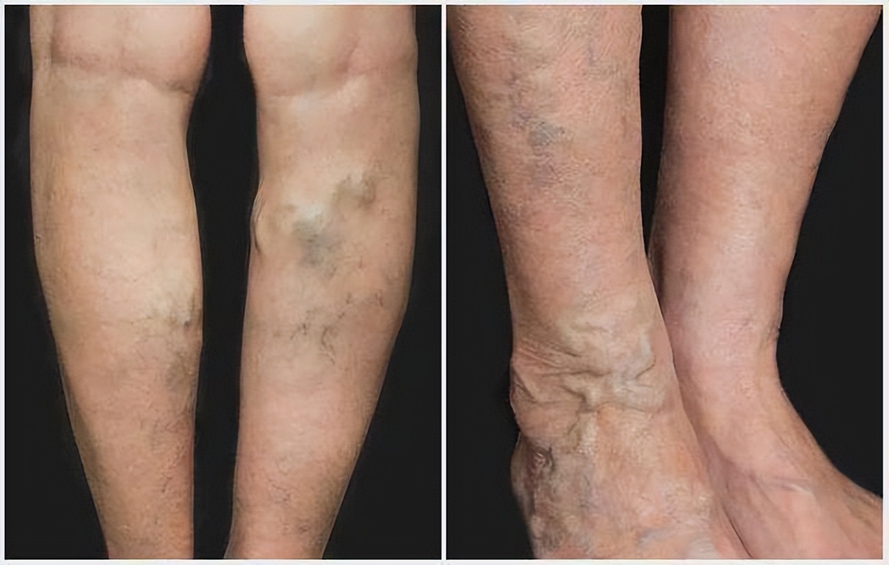 女性宫颈出问题腿部有什么反应,女性宫颈出现病变