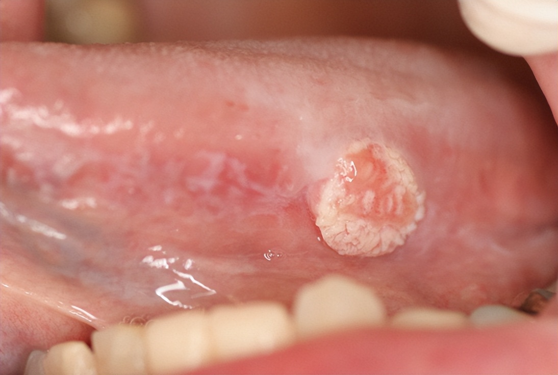 自己咬了一口会怎么样,一不小心咬到自己的伤口