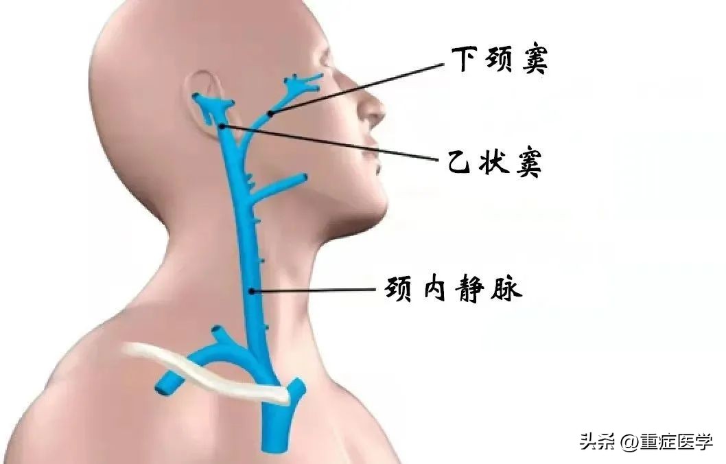 保姆级深静脉穿刺全攻略，建议收藏！