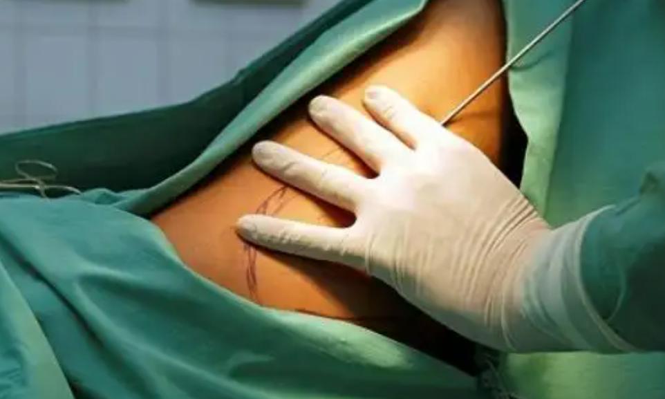 女子因抽脂手术感染身亡,女子抽脂感染去世