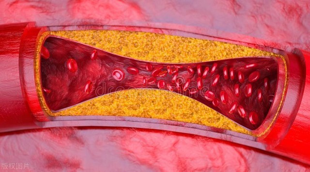 每天吃4个鸡蛋得了心脏病案例,每天一个鸡蛋能得心梗吗