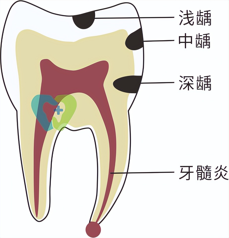 补牙牙齿咬合疼痛是怎么回事,牙齿敏感补牙咀嚼痛