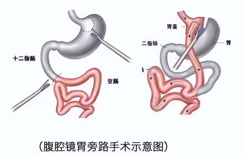 全球有30%因肥胖而死亡,全球每年280万人因肥胖死亡