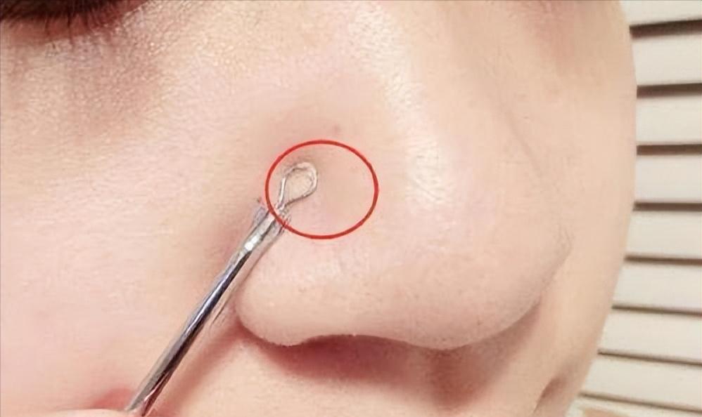 去鼻子上的黑头最好的方法,去鼻子上黑头的有效方法