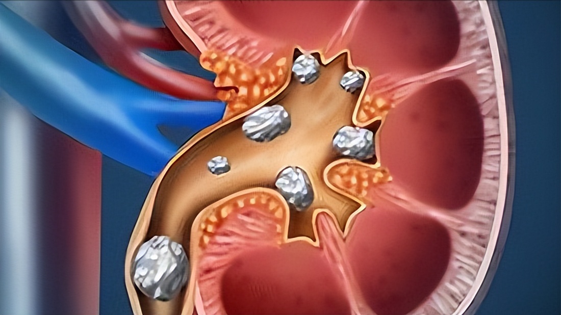 泌尿系统结石是什么原因导致的,泌尿系统结石的症状是什么