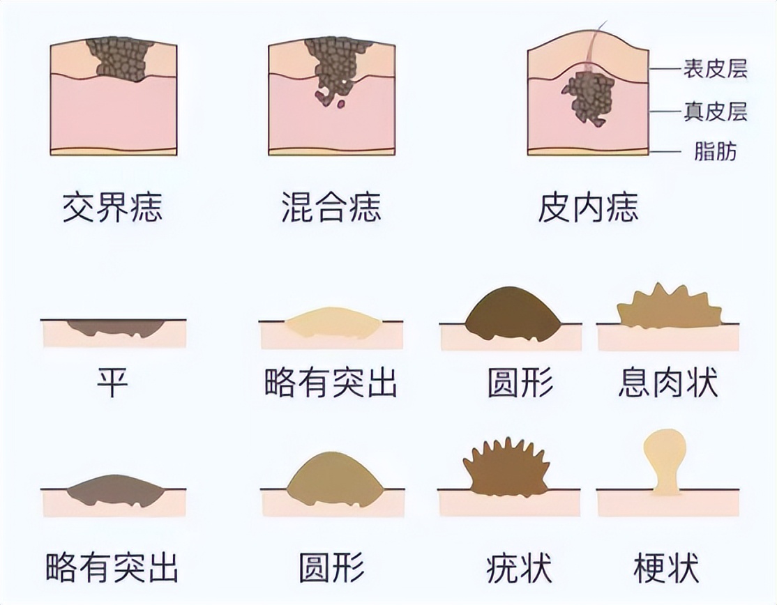 谈痣色变,身上长的痣都是色素痣吗