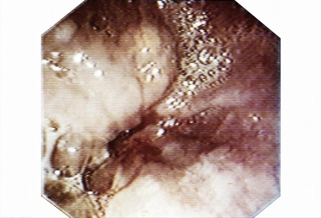 40岁左右的男子突然咳嗽,咳白色泡沫痰五六年反复是肺癌吗