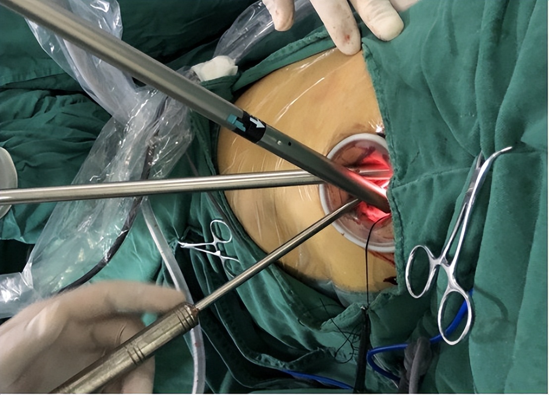 胸腔镜下胸膜冷冻活检，在胸腔积液诊断中，有价值和安全性么