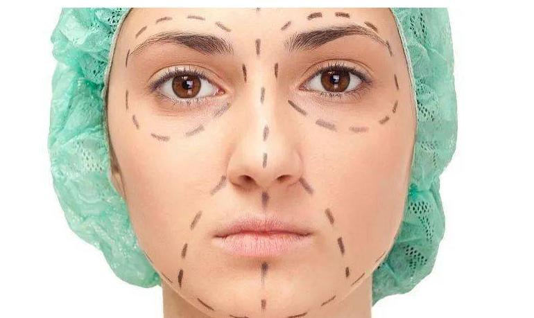 韦敏面部吸脂,九院韦敏植骨手术案例