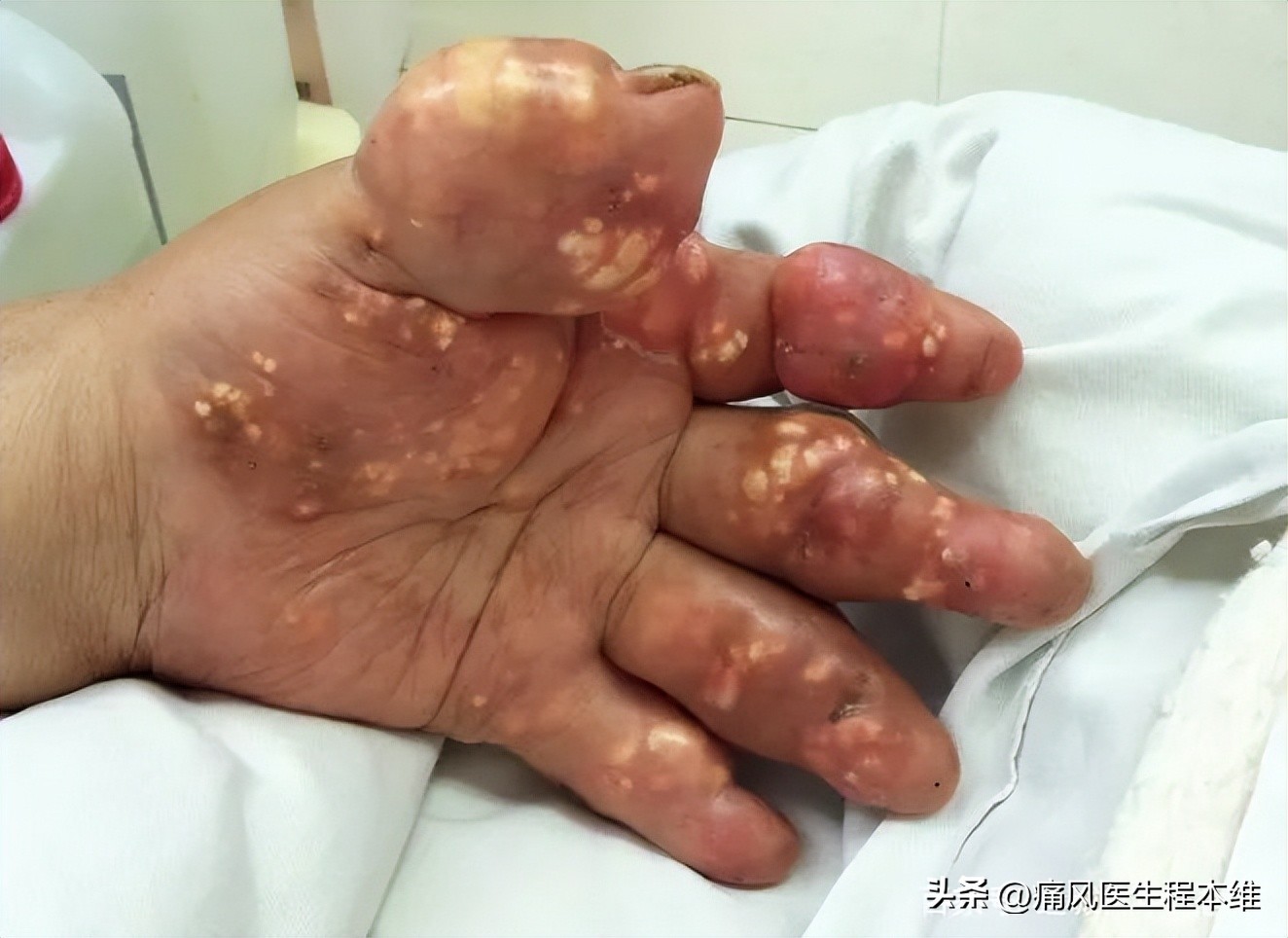 尿酸高最怕三种水,尿酸高这四种水别喝