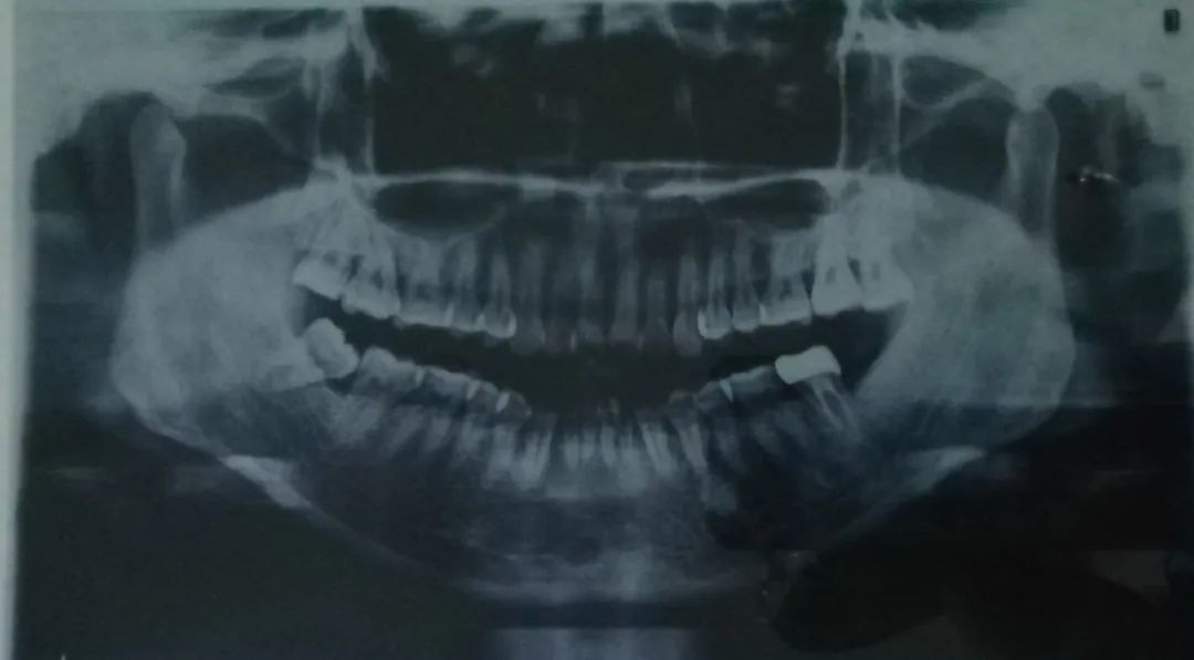 整牙亲身经历分享一下,整牙的经历分享