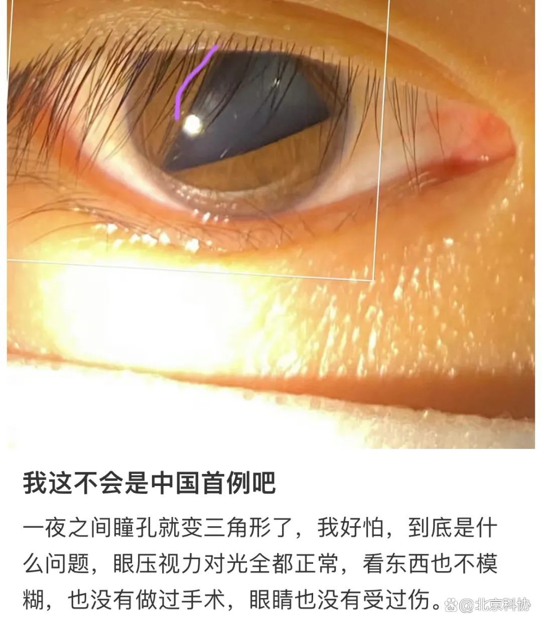 网友瞳孔突然变成三角形可治好吗,瞳孔变成了心形怎么回事