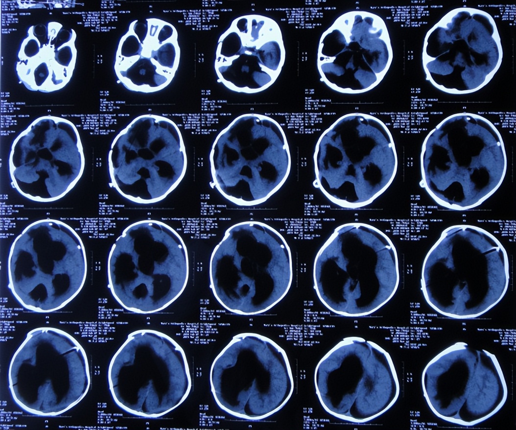 蛛网膜囊肿合并脑积水腹腔分流术,治疗蛛网膜囊肿引起脑积水严重吗