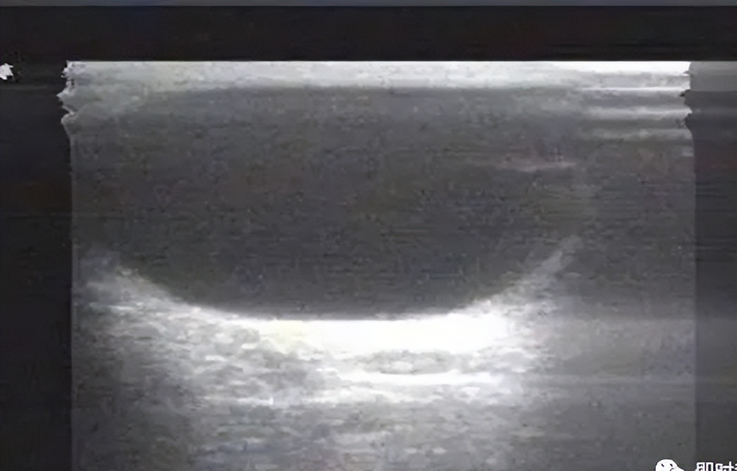 腋窝包块超声鉴别诊断,腋窝淋巴结检查法