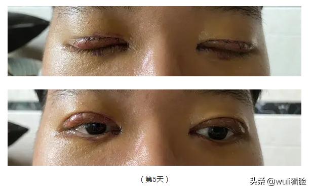 男生割双眼皮的意思,男生眼睛小割双眼皮会好看吗