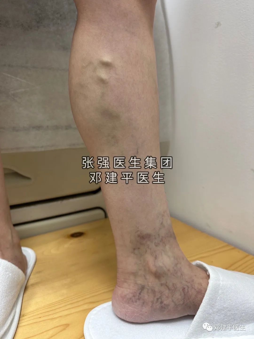 下肢静脉曲张非手术治疗护理,下肢静脉曲张2级吃药可以消除吗