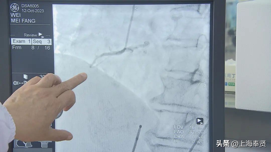 急性心肌梗死遇上“电风暴”,奉城医院多科室携手跑赢“死神”→