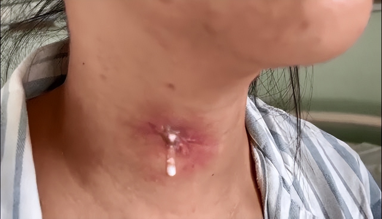 男子咽痛不适,长期一侧咽痛误诊