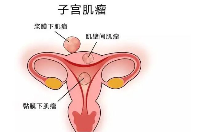 子宫腺肌瘤吃辣椒会发炎吗,有子宫肌瘤的可以吃辣椒吗