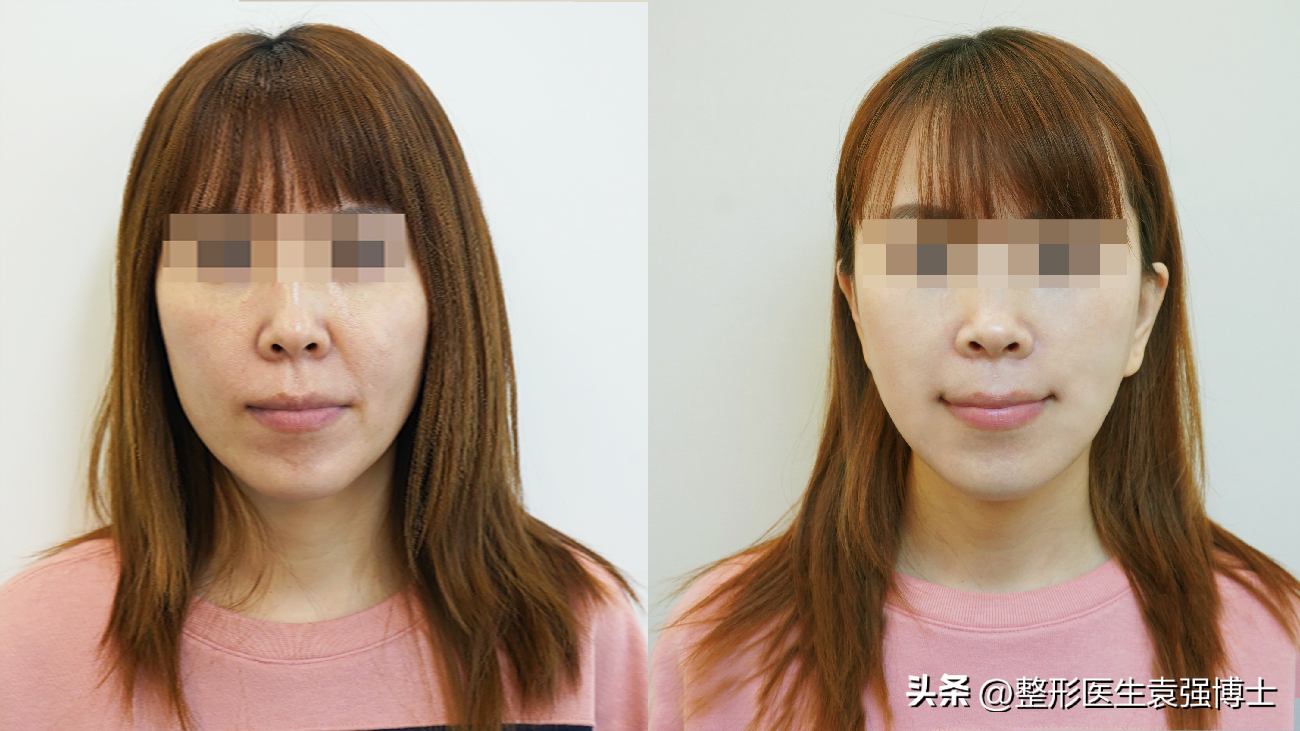 不做拉皮如何改善法令纹,法令纹严重拉皮可以改善吗