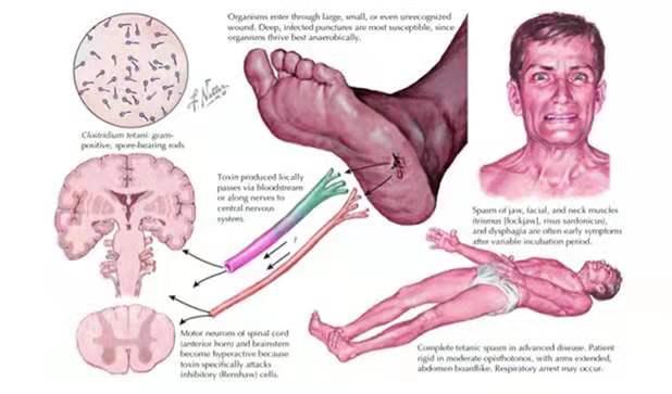 被猫咬后72小时打破伤风,被猫咬出破伤风的病例