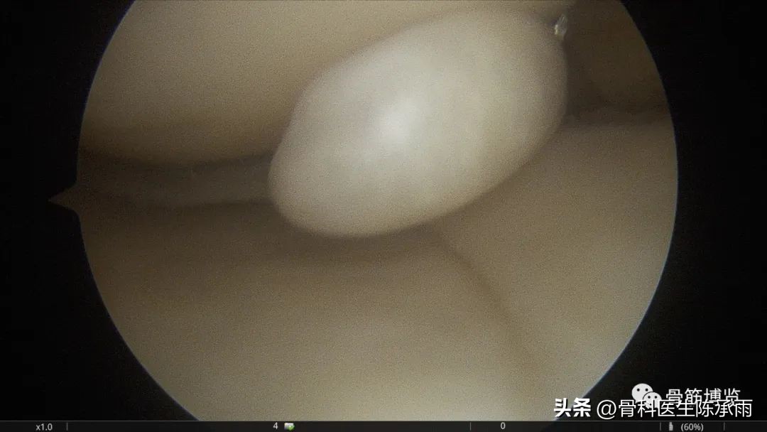 盘状半月板撕裂一级,半月板层裂愈合概率