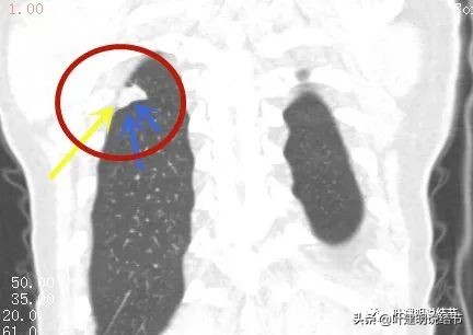 肺腺癌高危亚型什么意思,肺腺癌高危亚型